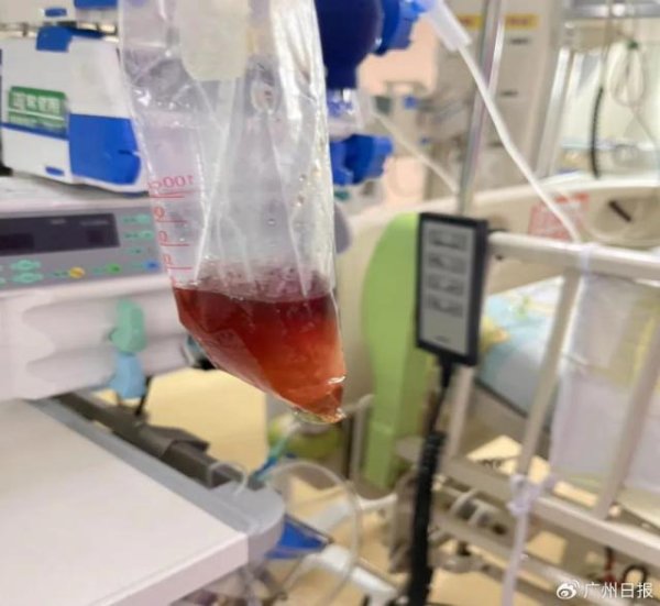 传金所配资 吃了一包零食，5岁娃进了ICU，蚕豆病广东高发